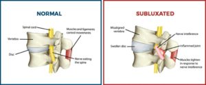 Chiropractic Subluxations
